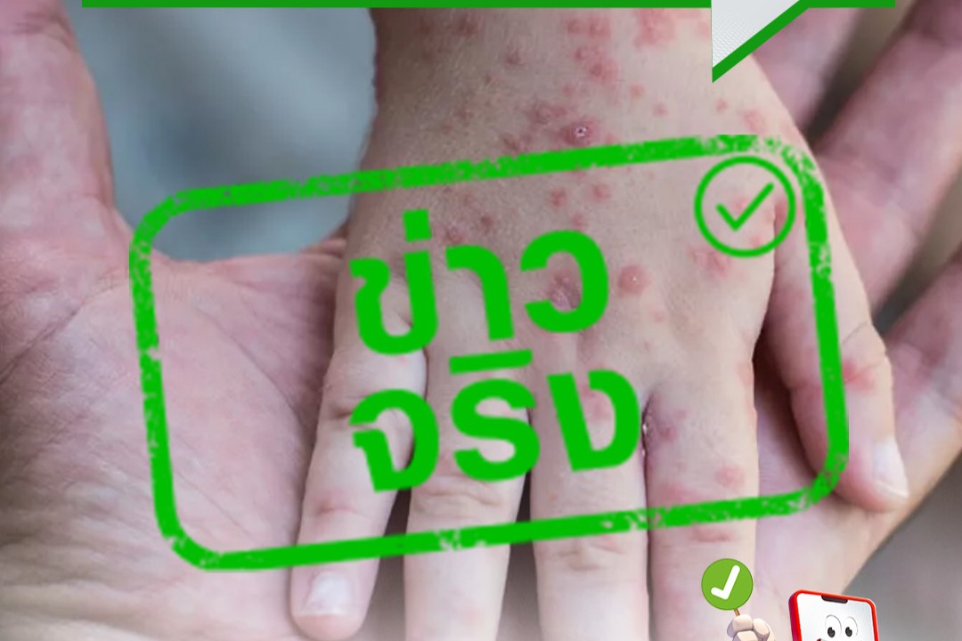 ข่าวจริง “โรคฝีดาษลิง ติดจากการสัมผัสใกล้ชิด หากอาการไม่รุนแรงรักษาให้หายได้”